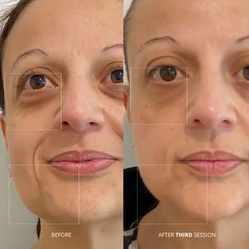 WonderFace facial contouring results — Eye Bags