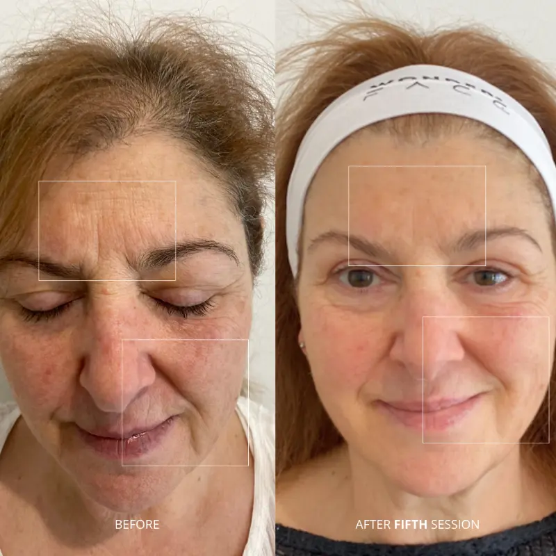 WonderFace facial contouring results — Forehead