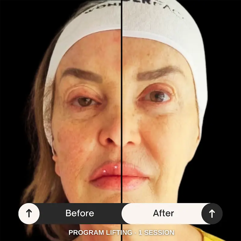 WonderFace facial contouring results — Face Lifting