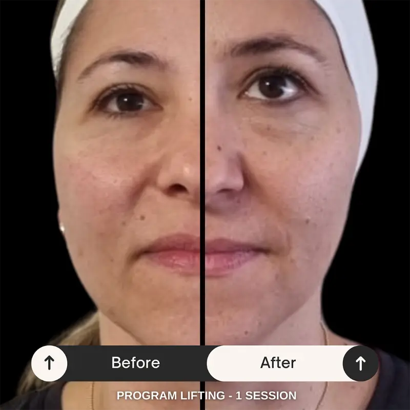 WonderFace facial contouring results — Face Lifting