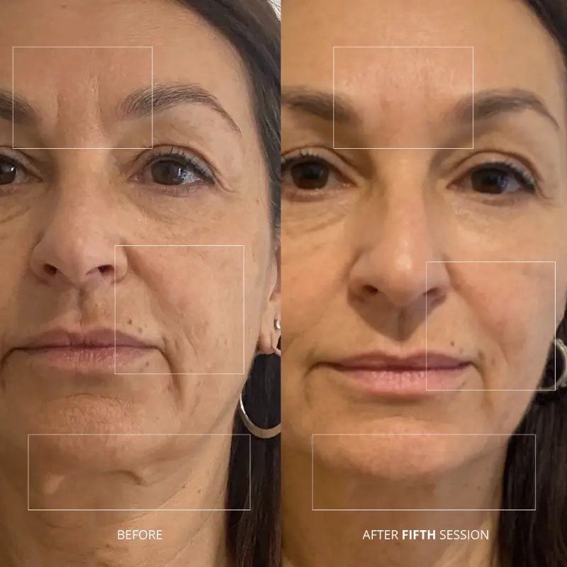 WonderFace facial contouring results — Neck & Forehead