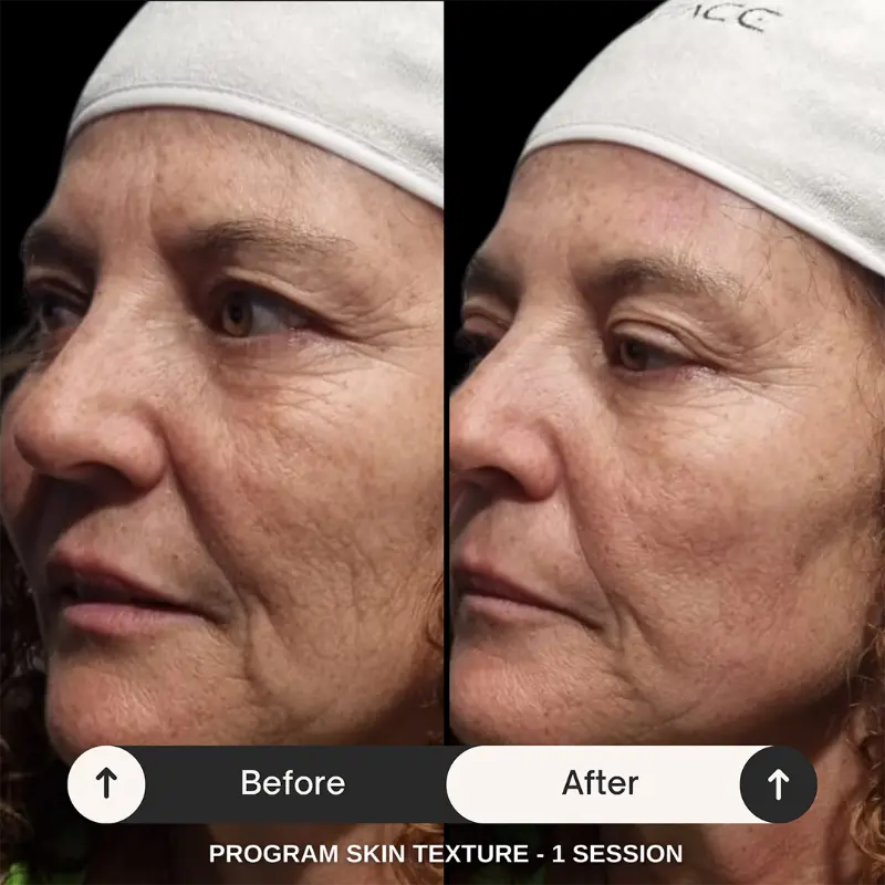 WonderFace facial contouring results — Skin Texture
