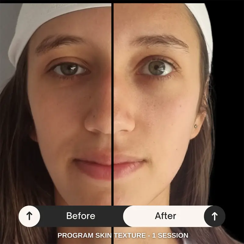 WonderFace facial contouring results — Skin Texture